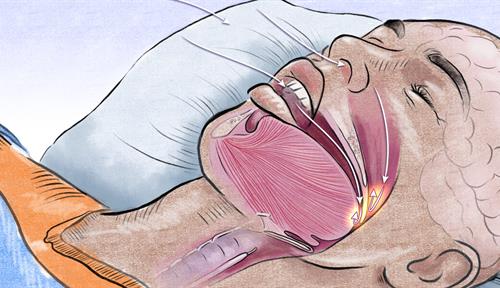 Drawing of a sleeper with apnea whose tongue has blocked his throat passage, obstructing his breath and awaking him.