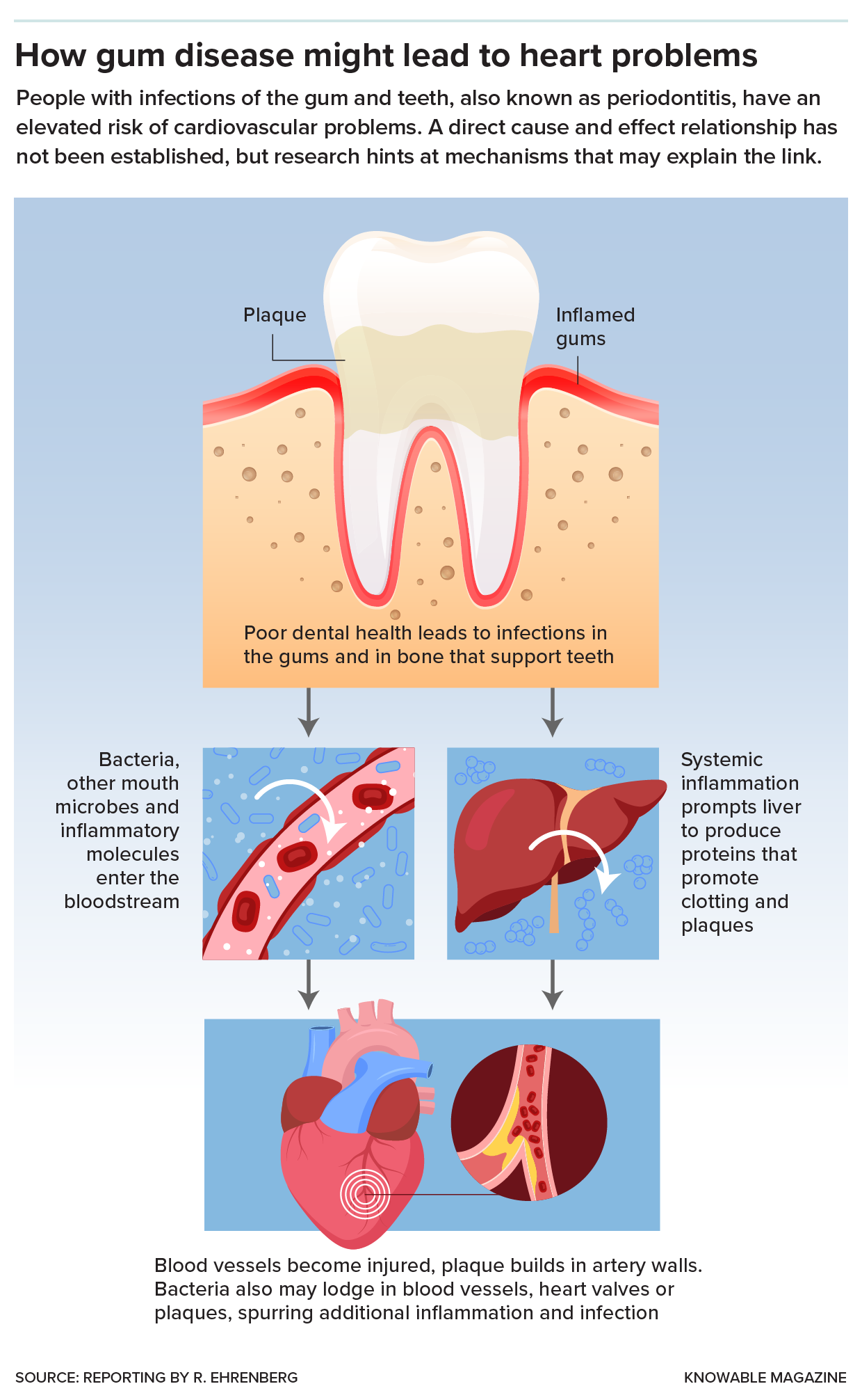 Graphic shows how chronic inflammation in the mouth, and oral bacteria, could lead to cardiovascular problems.